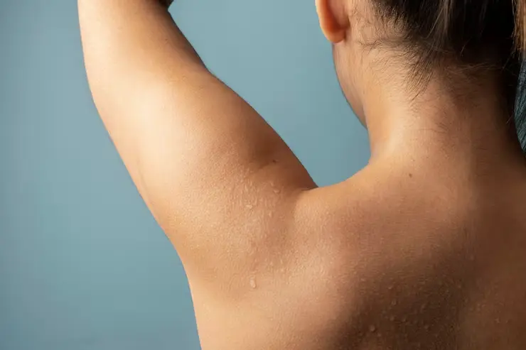 Tratamiento del exceso de sudoración e hiperhidrosis axilar en Esthetia Oliva